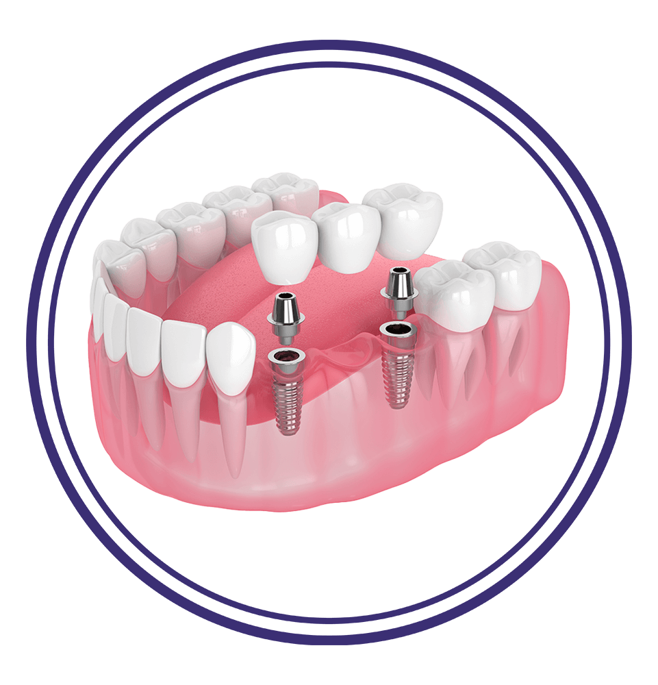 dental bridge
