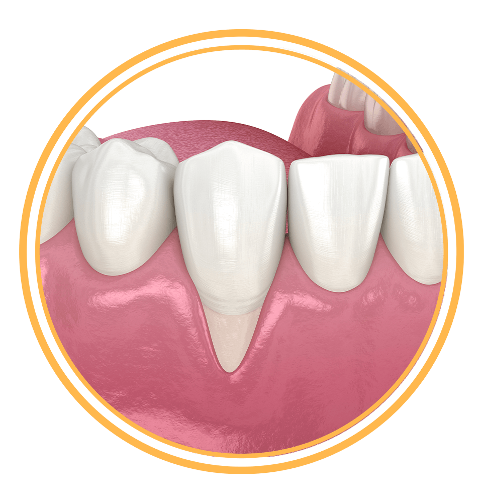 gum recession