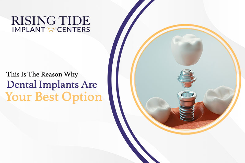 This Is The Reason Why Dental Implants Are Your Best Option